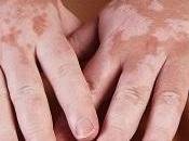 Remedios caseros para vitiligo