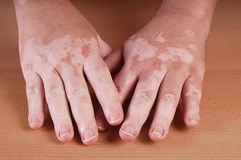 imagen de vitiligo