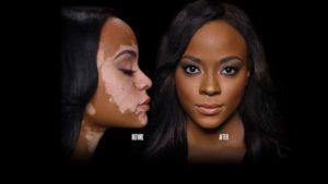 maquillaje para el vitiligo