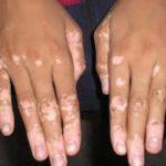 tipos de vitiligo