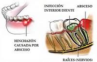 Absceso dental en el Antiguo Egipto