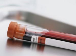 analisis sangre fiv 300x223 Diagnóstico de la Fibrosis Quística