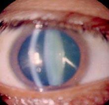 catarata2 Tipos de cataratas II