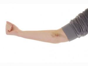 salud-como-evitar-hematomas-la salud como evitar hematomas la 300x224 Homeopatía para los golpes