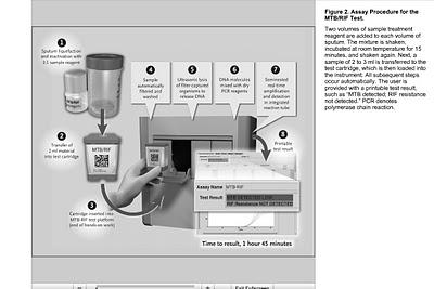 Diagnóstico rápido de DNA de tuberculosis en 2 horas
