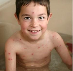 varicela2 300x290 Homeopatía en casos de varicela en niños