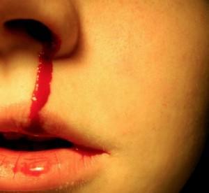 zz4a52110b 300x276 Hemorragias de nariz, causas y tratamiento   I