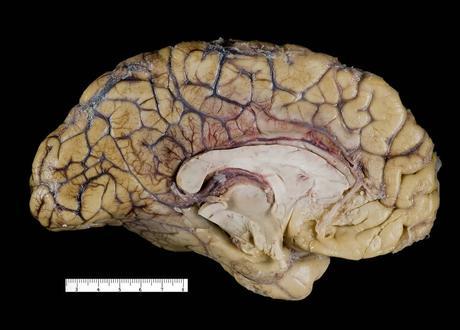 Fotografia Medica Seccion De Cerebro Humano