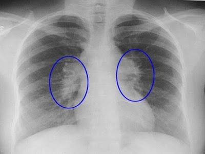 Sarcoidosis: Un diagnóstico a tener en cuenta en Atención Primaria.