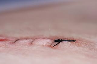 Me han operado, ¿Cómo curo la herida en casa? Me han operado, ¿Cómo curo la herida en casa?