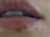salido herpes, ¿que hago?