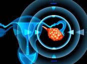 Cistoadenomas: usted necesita saber acerca estos quistes ováricos