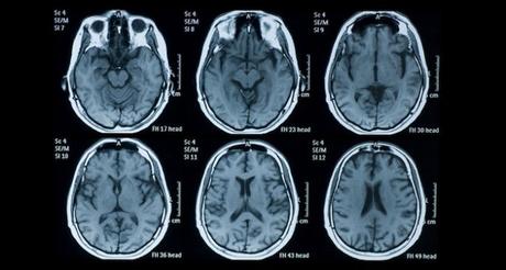 El ayuno cómo puede salvar su cerebro (y ¿Por qué las grandes empresas farmacéuticas no lo estudiaran?)