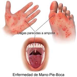 La Enfermedad de Manos Pie y Boca