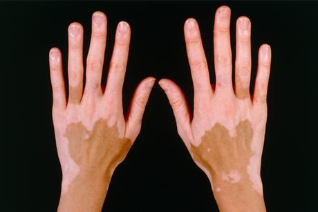 El Vitiligo es Causado por Factores Geneticos