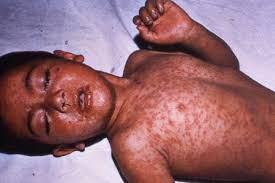 measles