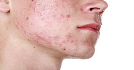 la-noticia-que-todos-los-que-sufren-de-acne-querian-escuchar