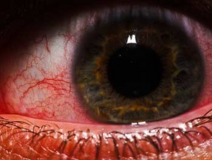 297 oeil rouge s  Homeopatía para tratar heridas en el ojo