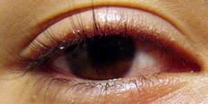 blefaritis cronica 300x151 Homeopatía en casos de cuerpos extraños en el ojo