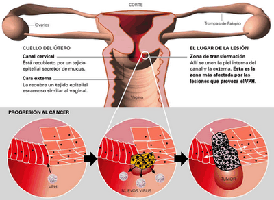 CANCER DE CUELLO DE UTERO