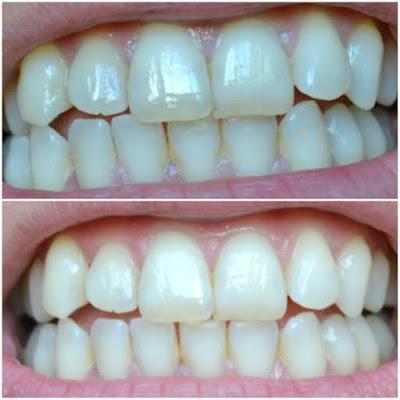 resultados del antes y después del blanqueamiento dental