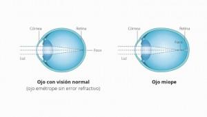 La “ epidemia de la miopía ” ya abarca cerca de la mitad de la población mundial joven.