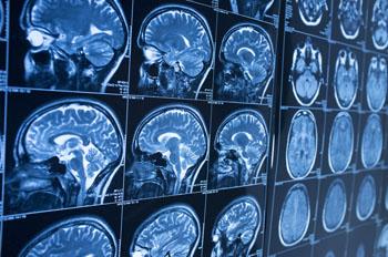 Programa informático supera a radiólogos en análisis de RM cerebrales