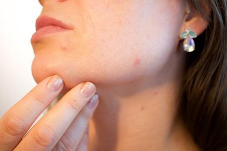 Piel con acné: peligros y tratamientos