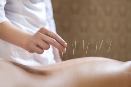 Los beneficios de la acupuntura para la salud
