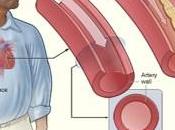 Aterosclerosis Complicaciones