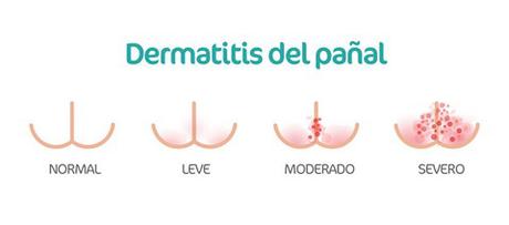 Dermatitis del pañal