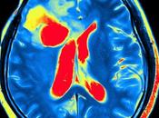Nueva técnica escaneo cerebral para remover memorias miedo
