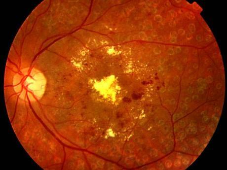 Diagnostico de Retinopatia Mediante el Aprendizaje Profundo