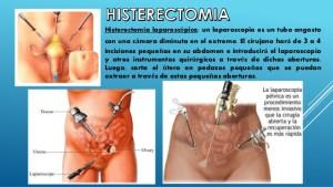 histerectomia útero