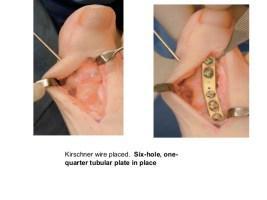 Cirugía de hallux valgus Cirugía de hallux valgus