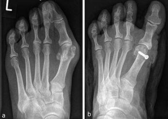 Juanetes. Hallux valgus Juanetes. Hallux valgus