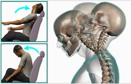 Cambios en el Flujo Cerebral seria la Causa del Latigazo Cronico