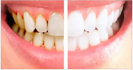 Eliminar la placa dental con remedios naturales