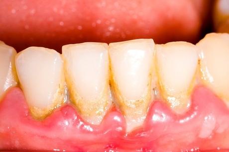 como eliminar la placa dental con remedios caseros