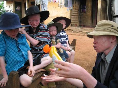 Ébano y marfil: la persecución del albinismo en África Ébano y marfil: la persecución del albinismo en África