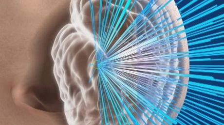 Sin bisturí ni anestesia: La increíble cirugía cerebral con ondas de sonido que curó a un paciente con temblores