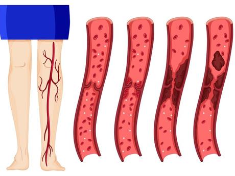¿Qué debo saber acerca de la Trombosis Venosa Profunda?