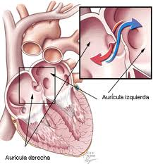 Foramen oval permeable