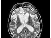 Fumar lleva Esclerosis Lateral Amiotrofica