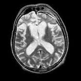 Fumar lleva a Esclerosis Lateral Amiotrofica Fumar lleva a Esclerosis Lateral Amiotrofica