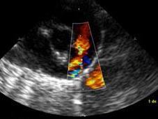 Revisión sobre Ductus Arterioso Fetal anomalías