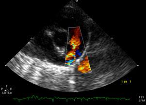 Revisión sobre el Ductus Arterioso Fetal y sus anomalías