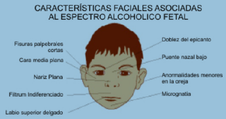 Incidencia Mundial del Sindrome de Alcoholismo Fetal