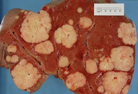 El mayor proyecto para evaluar lo que sabemos sobre el cáncer da sus primeros resultados y no son buenos