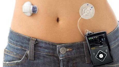 El páncreas artificial cada vez más cerca de los diabéticos